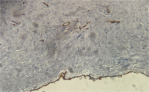 CD34 positivity in endothelial cells, supporting the diagnosis of lymphangioma.