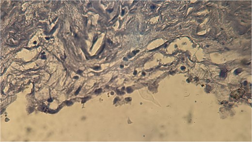 Negative calretinin staining ruling out a mesothelial origin.