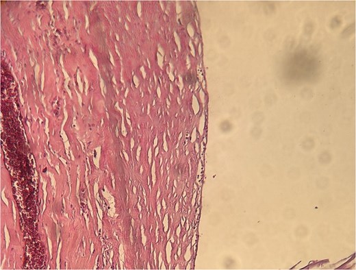 Microscopic appearance of the cystic lymphangioma identified in Case 3.