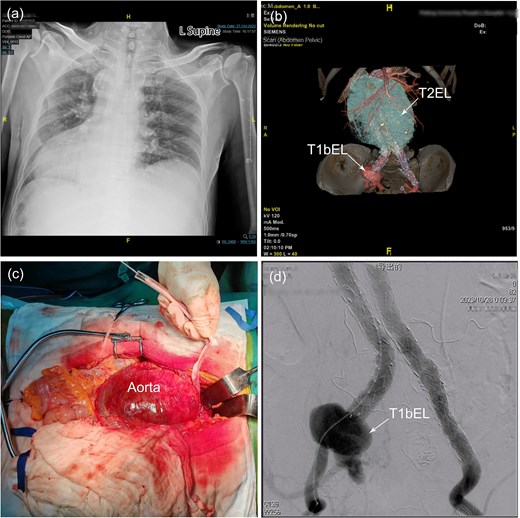 (a) Chest X-ray shows dextrocardia and dilation of the mediastinal shadow. (b) Contrast-enhanced computed tomography demonstrated a previous stent–graft placement, a type II endoleak with a giant aneurysm sac, a distal right common iliac artery dilatation with a type Ib endoleak. (c) Identification of a huge infrarenal aortic aneurysm through a mid-abdominal incision and was subsequently controlled with a sleeve to facilitate subsequent surgical procedures. (d) Angiography revealed a significant type Ib endoleak in the distal to the right common iliac branch. AA, abdominal aorta; CIA, common iliac artery; LRA, left renal artery; RRA, right renal artery; T1bEL, type 1b endoleak.