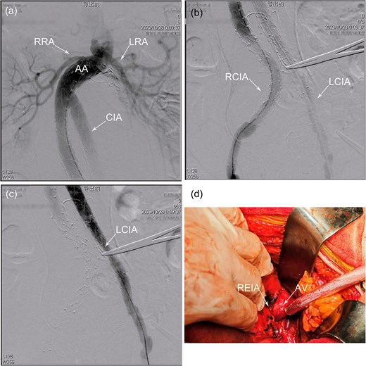 (a) Proximal angiography showed occlusion of the back-bleeding side branches leading to type II endoleak. (b) Distal angiography revealed an effective isolation of a type 1b endoleak in the right common iliac artery, but there was an absence of the right internal iliac artery. (c) After relining the graft with an additional branched iliac device, angiography confirmed the successful isolation of a type III endoleak, with no contrast leakage observed between the iliac branch and the main body of the stent graft. (d) No active bleeding was observed at the bilateral anastomoses or within the graft following the release of the aortic clamp. AV, artificial vessel; LCIA, left common iliac artery; LIB, left iliac branch; RCIA, right common iliac artery; REIA, right external iliac artery; RIB, right iliac branch.