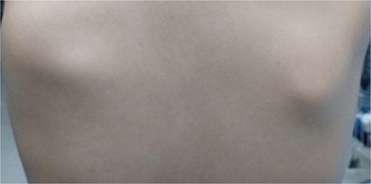 Preoperative clinical presentation showing pseudo-winging of left scapula.