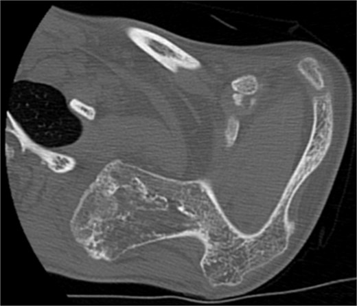 CT of the 14-year-old patient showing the largest lesion arising ventrally from the superior angle of left scapula in axial plane.
