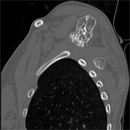 CT of the 14-year-old patient showing both lesions in sagittal plane.