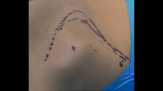 Intraoperative images of the marking of the modified Judet approach at the older patient.