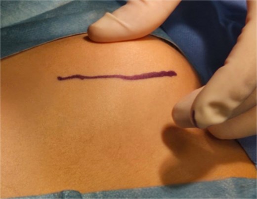 Intraoperative images of the marking of the modified Judet approach at the younger patient.