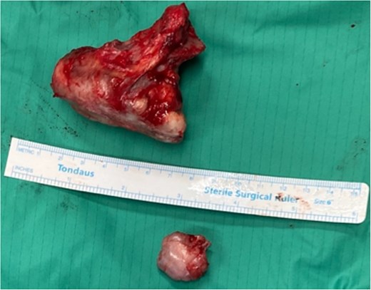 The gross specimens of the ventral scapular osteochondromas of the older patient after en bloc excision.