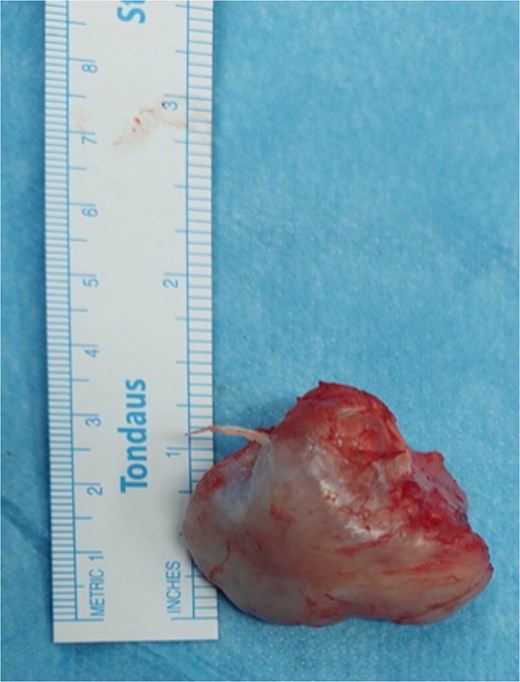 The gross specimen of the ventral scapular osteochondroma of the younger patient after en bloc excision.