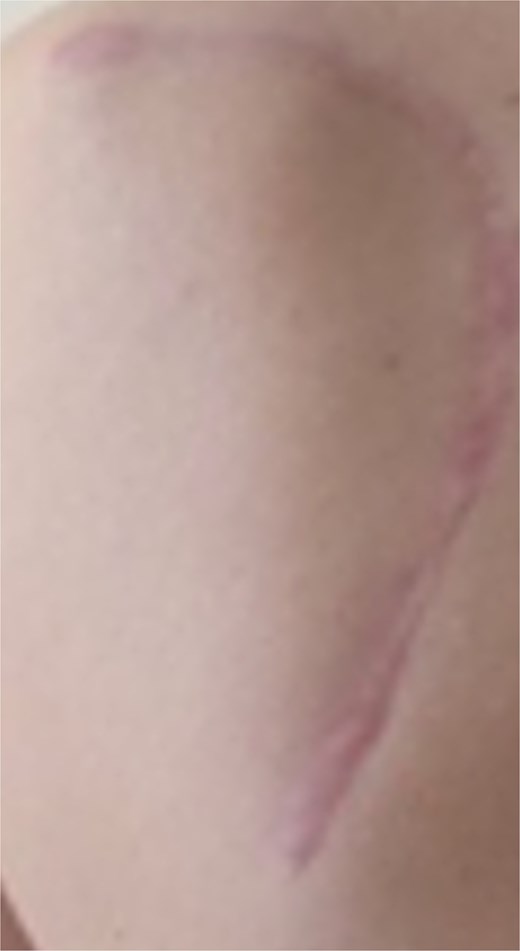 Postoperative clinical assessment without scapular prominence.