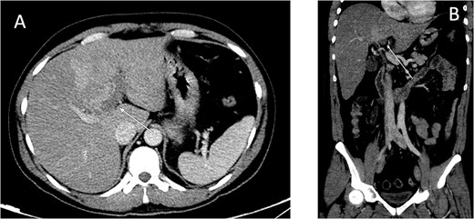 Contrast-enhanced CT scan of the abdomen: (A) axial cut; (B) coronal cut. Arrow indicates left portal vein thrombosis.