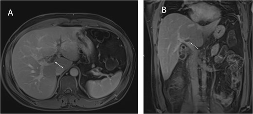 MRCP T1-weighted images: (A) axial cut; (B) coronal cut. Arrow indicates left portal vein thrombosis.