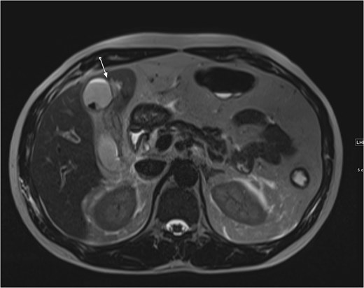 Axial cut MRCP showing T2-weighted images. Arrow indicates area of micro-perforation and small collection.