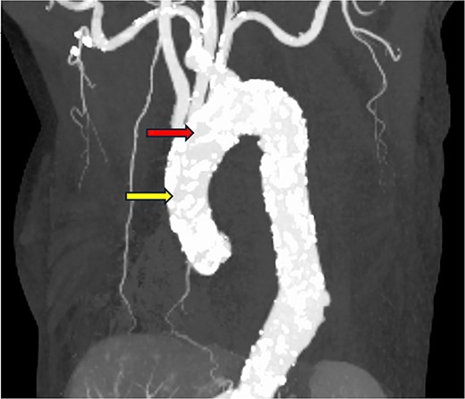 The ascending aorta is severely calcified. The red arrow indicates the arterial cannulation site, and the yellow arrow indicates the proximal anastomosis site of the vein graft.