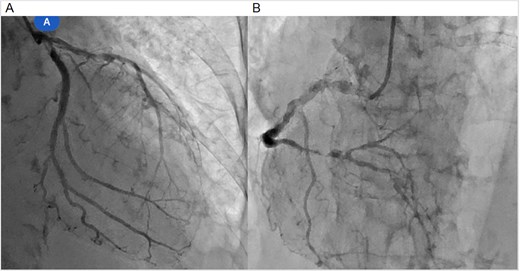Coronary angiography: (A) left coronary artery and (B) right coronary artery.