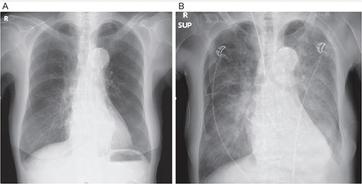 Chest X-ray: (A) immediately and (B) at the time of decompensation.