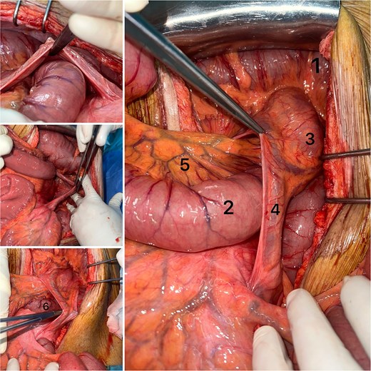 Left anterior paraduodenal hernia. (1) left colic flexure, (2) ileum, (3) descending mesocolon, (4) ascending left colic artery, (5) mesentery, (6) jejunum.