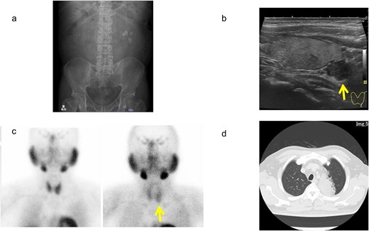 Imaging findings of urinary calculus, as well as parathyroid and lung lesions. (a) Kidney–ureter–bladder radiograph. (b) Ultrasonography of the cervix. (c) 99mTc-methoxy isobutyl isonitrile scintigraphy. (d) Chest computed tomography. Arrows indicate tumor areas.