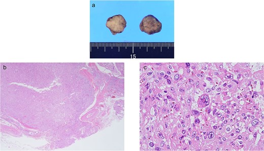 Gross and pathological findings of the parathyroid carcinoma. (a) The excised left lower parathyroid gland. (b) Pathologically, the fibrous septum was broken, and extracapsular infiltration was observed (magnification 2×). (c) A mixture of multinucleated and megakaryocytes was observed (magnification 400×).