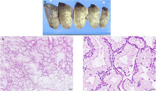 Gross and pathological findings of the lung cancer. (a) Gross findings with segmented lungs. (b, c) Tumor cells form glandular duct structure with alveolar epithelial replacement. (b) Median (magnification 100×) and high-power (magnification 400×) images.
