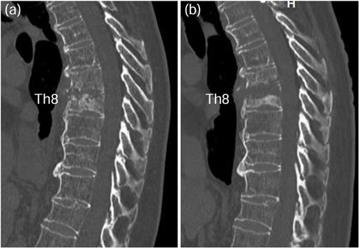 CT scan revealed osteolysis of the Th7-Th8 vertebral endplates and DISH upon admission (a). Four weeks later, progression of destructive changes at the Th7-Th8 endplates was observed (b).