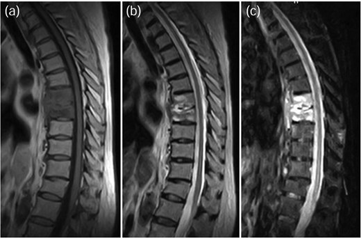 MRI demonstrated signal changes at Th7-Th8, with low intensity on T1-weighted images (a), high intensity on T2-weighted images (b), and no suppression on short-tau inversion recovery (STIR) images (c).