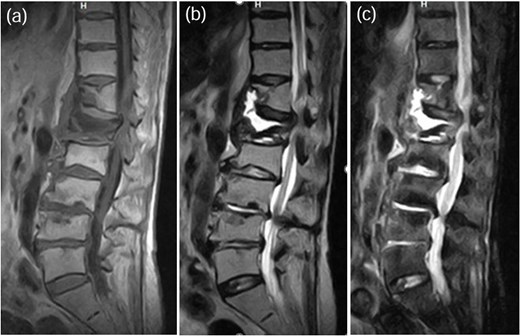 MRI demonstrated fluid signals in the L1 vertebral body and the anterior paravertebral area at Th12-L1. These were low-intensity on T1-weighted images (a) and high-intensity on T2-weighted images (b) and not suppressed on STIR images (c).