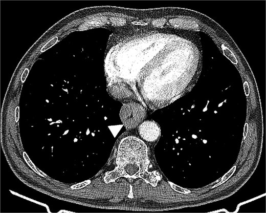 Chest computed tomography revealed esophageal wall thickening up to 31 mm, resulting in significant luminal stenosis.