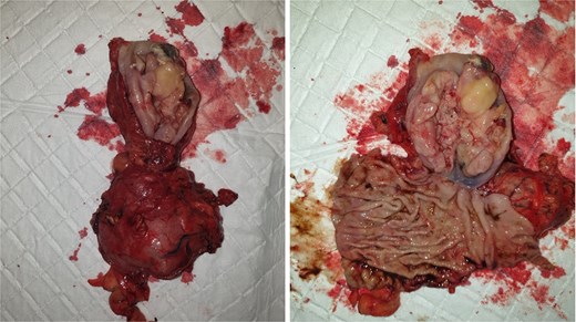 Macroscopic findings of the resected specimen. Gross appearance of the resected esophageal specimen.