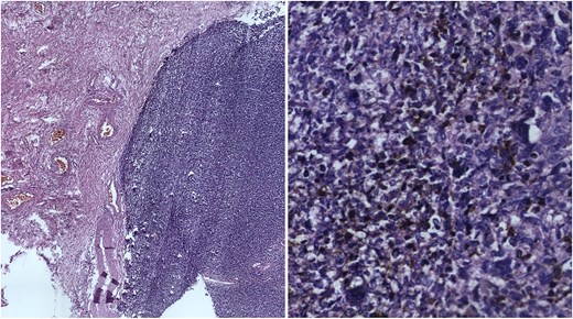 Microscopic findings of the resected specimen. Microscopic view (H&E) showing malignant pigmented spindle-cell melanoma with ulceration and necrosis.