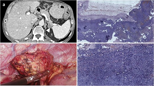 Radiological, intraoperative, and histopathological findings of adrenal metastasis. (a) Computed tomography revealing a 20.5-mm mass in the left adrenal gland extending toward the pancreatic tail. (b) Intraoperative view of the adrenal mass. (c and d) Microscopic examination (H&E) showing malignant pigmented melanoma within adrenal gland tissue.