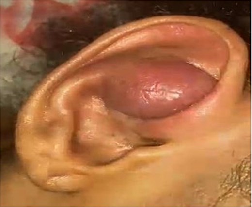 This figure showed a firm, progressively darkening mass is observed on the right ear pre-operation.