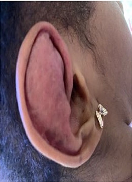 Shows a persistent, enlarging right auricular mass consistent with a recurrent hematoma following prior surgical excision.