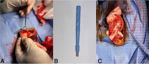 (A) Surgical approach incision at scapha-helical rim exposes split cartilage and hematoma. (B) Dermal punch tool specialized instrument used for hole punch technique to remove affected cartilage. (C) Post-operative care suture, drain, cotton-wool roll, and vaseline gauze maintain ear shape during recovery.