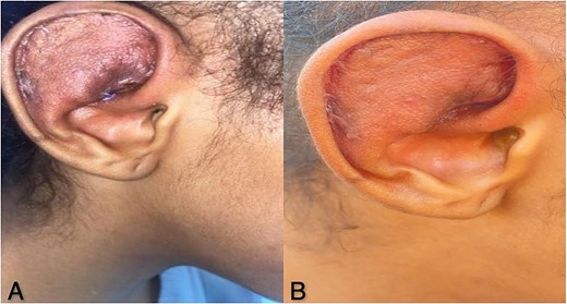 (A) Excellent post-operative result, the surgical site is well-integrated, indicating the effectiveness of the hole-punch technique. (B) Favorable outcome at 2 months, the favorable outcome is maintained 2 months after the procedure.