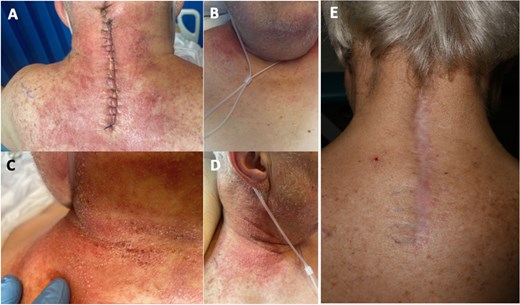 Post-operative day 2 pictures of erythematous, non-raised, posterior cervical wound (A), anterior upper chest (B), posterior neck crease with neck flexed (C), right neck showing pinpoint pustular heads (D), and 6 month follow-up cervical wound (E).