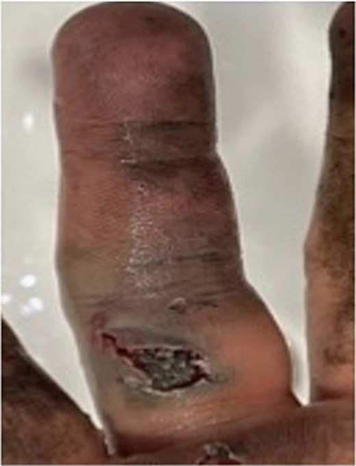 Image of patient one, showing his digit at presentation displaying large puncture wound on volar surface.