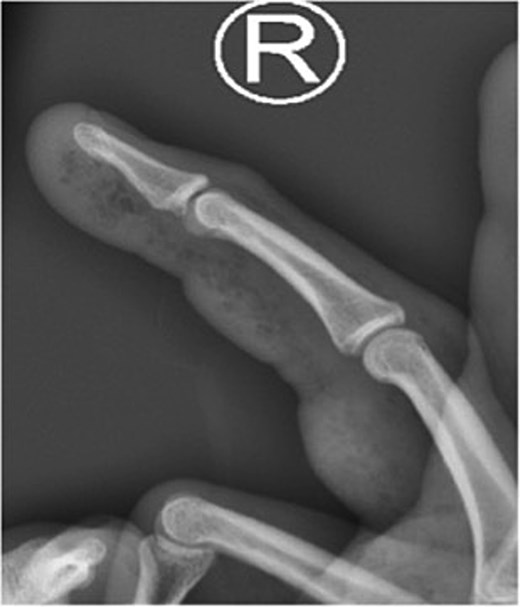 X-ray image of patient one showing injected material into volar surface of his digit.