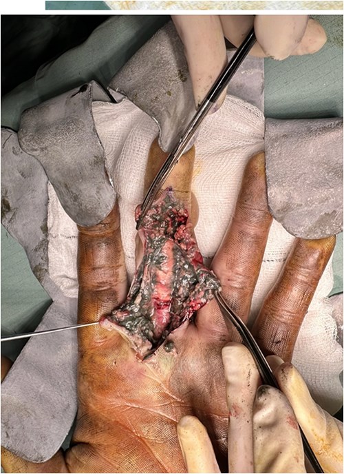 Intra op image of patient one’s original debridement.