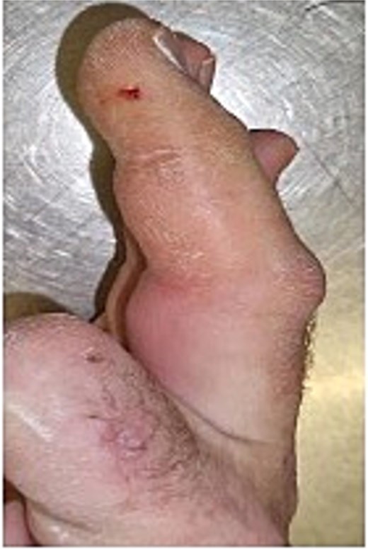 Image of patient two, showing his digit at presentation displaying very small puncture wound on lateral volar surface of his digit.