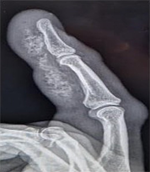 X-ray image of patient two showing injected material into volar surface of his digit.