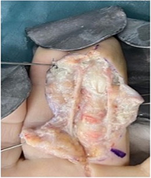 Intra op image of patient two’s original debridement.