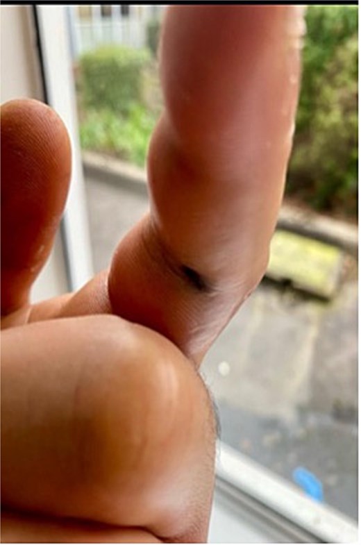 Image of patient three, showing his digit at presentation displaying small puncture wound on volar surface.