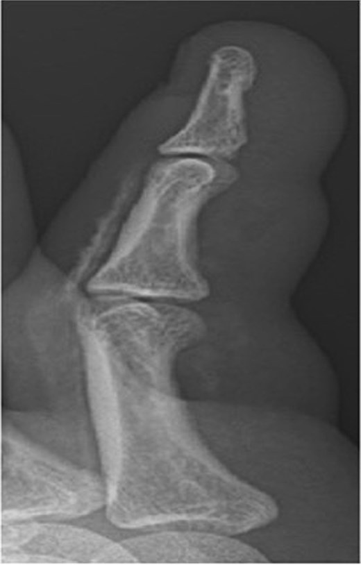 X-ray image of patient three showing injected material into surface of his digit, more obvious in the proximal portion.