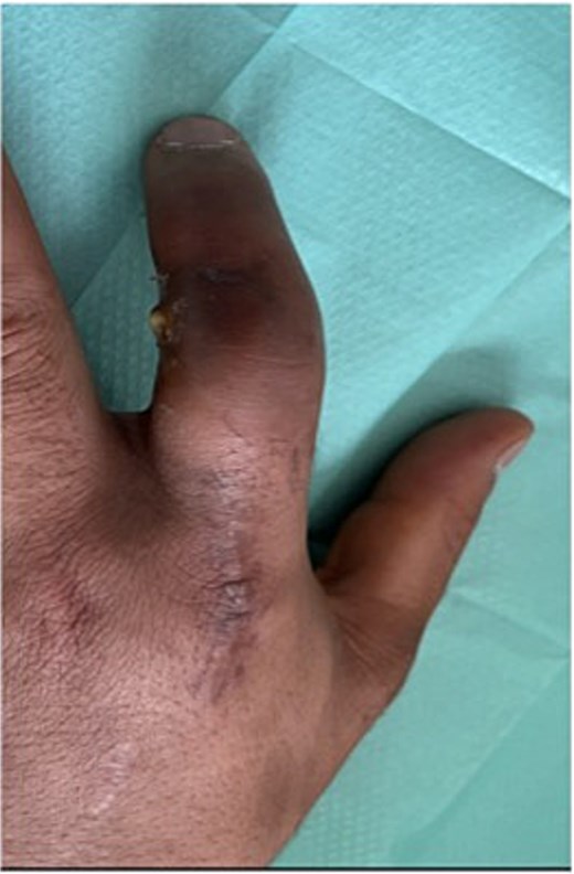 Patients three’s digit when he represented 2 months after original insult with a swollen finger in a flexed position and pus exudate.