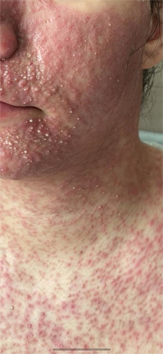 Hyperpigmented patches involving the face and upper trunk.
