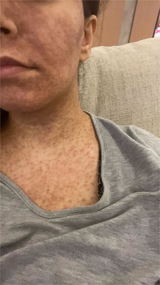 Complete resolution of patient’s rash.