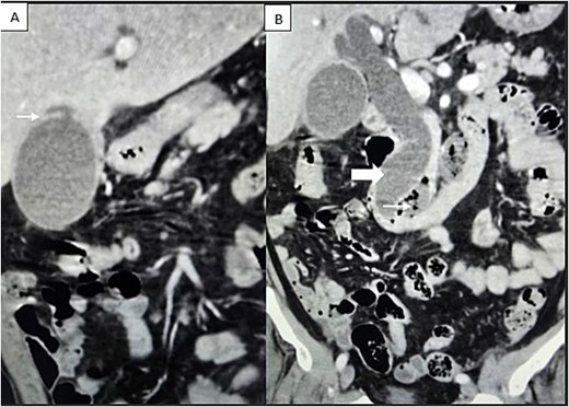 Contrast-enhanced CT scan demonstrating (A) localized perforation at the fundus of gallbladder (white arrow). (B) Extrahepatic biliary tract dilatation (big arrow); a periampullary duodenal diverticulum (small arrow).