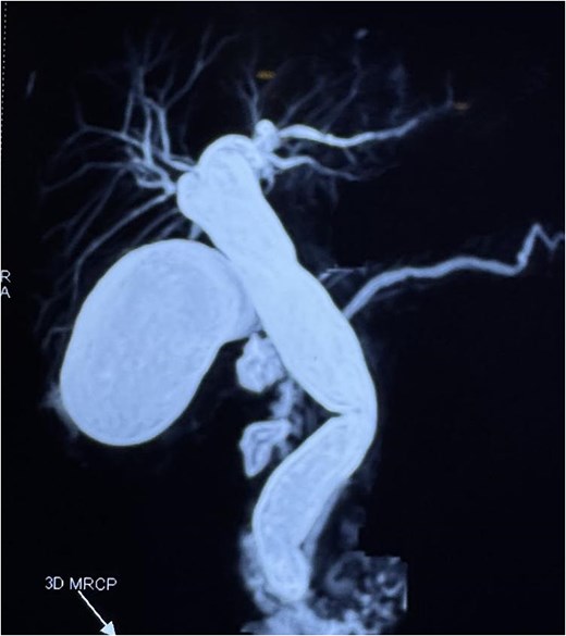 Magnetic resonance cholangiopancreatogram (MRCP) showing biliary stasis without any structural distal obstruction.