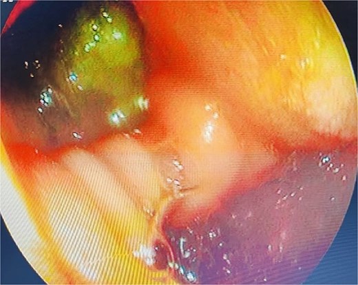 Upper gastrointestinal endoscopy showing duodenal diverticulum.