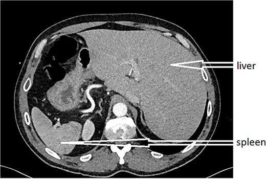 CT scan revealed situs inversus.